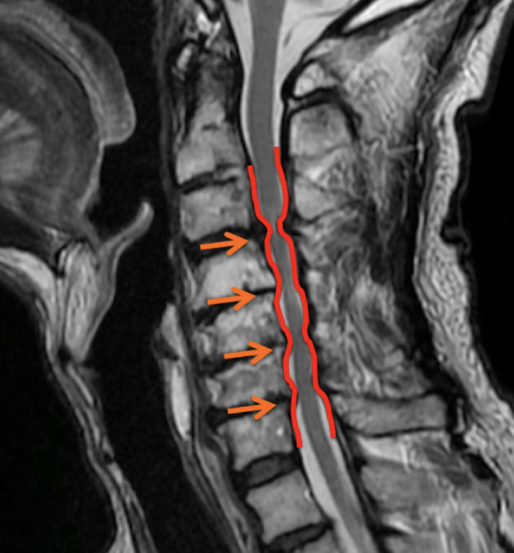 関節 脱臼 頚椎 頸椎脱臼骨折とは｜症状・治療法データベース
