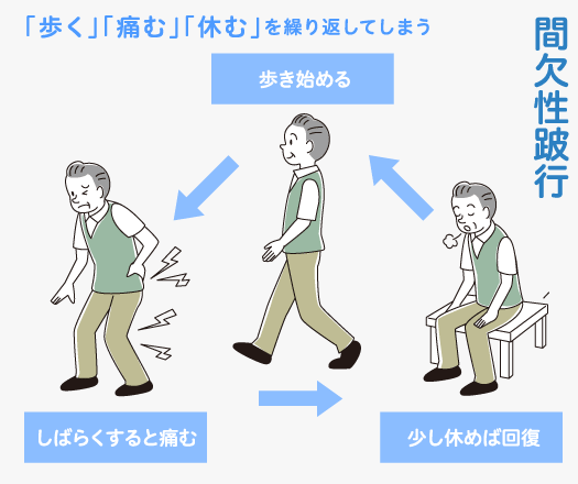 「歩く」「痛む」「休む」を繰り返してしまう　間欠性跛行