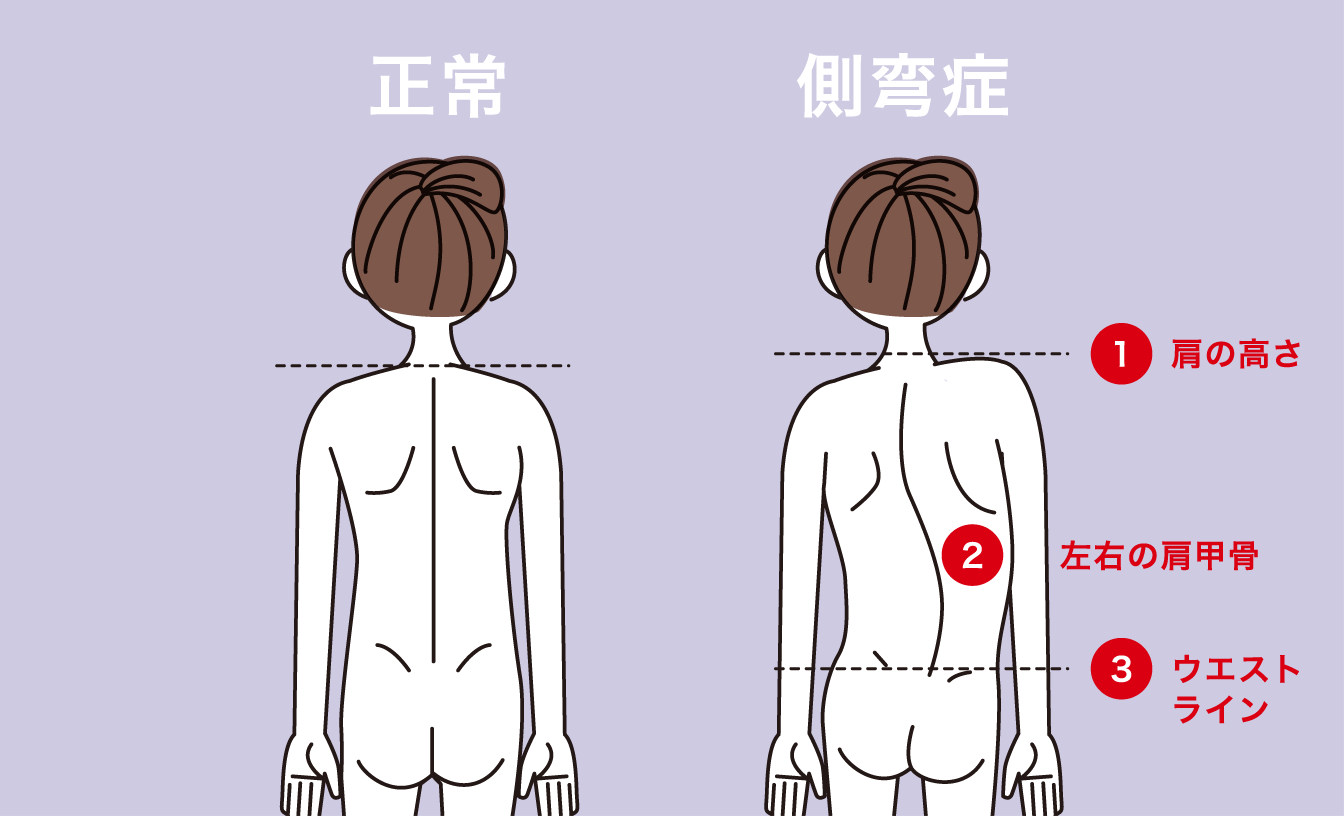 せぼねの曲がり 外科 群馬脊椎脊髄病センター 首の痛み 手足のしびれ 腰痛 曲がり 側弯症