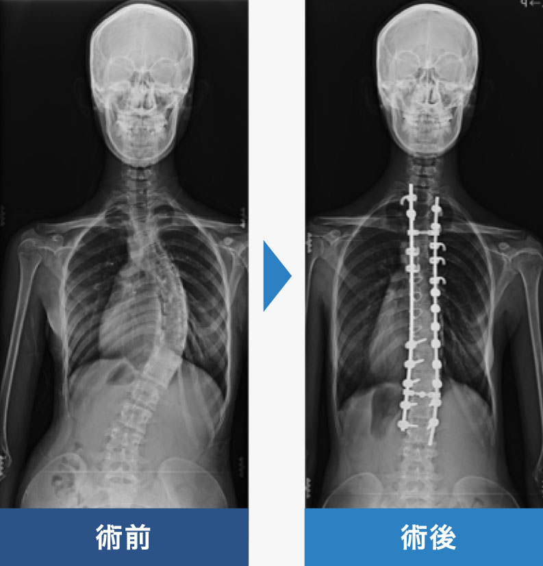 せぼねの曲がり 外科 群馬脊椎脊髄病センター 首の痛み 手足のしびれ 腰痛 曲がり 側弯症