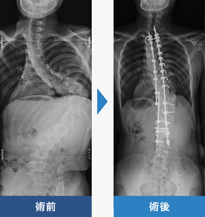 方 治し 側 弯症