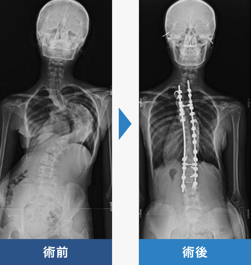 せぼねの曲がり 外科 群馬脊椎脊髄病センター 首の痛み 手足のしびれ 腰痛 曲がり 側弯症